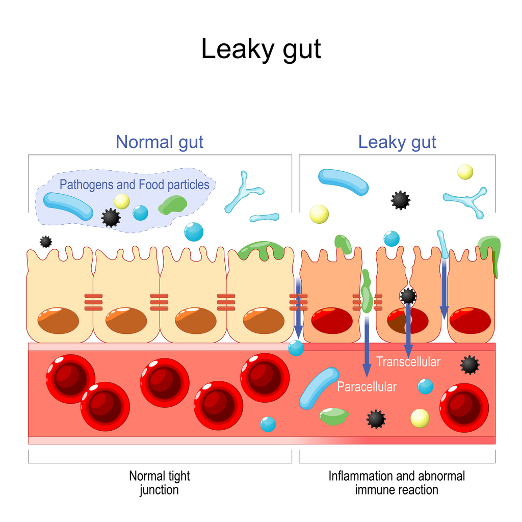 Leaky Gut Treatment: Causes & Symptoms